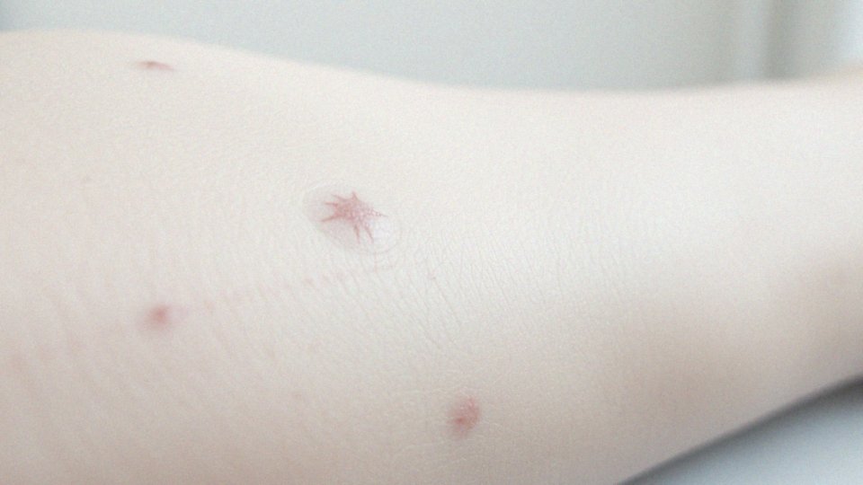 Jakie są przyczyny powstawania blizn zanikowych?